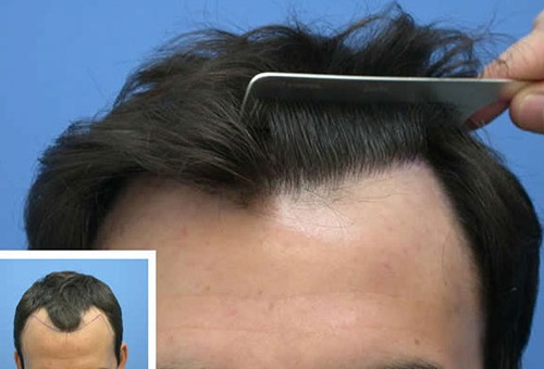 Фото до и после пересадки волос